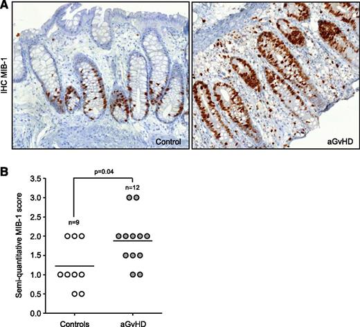 Figure 1. Increased cell proliferation in patients with aGVHD. (A) Representative MIB-1 immunohistochemical staining of the initial gut biopsies of a control (left) and an aGVHD patient (right). Shown magnification is ×20. (B) Immunohistochemical scoring of the MIB-1 staining shows a significant increase of proliferating enterocytes in aGVHD patients compared with controls.