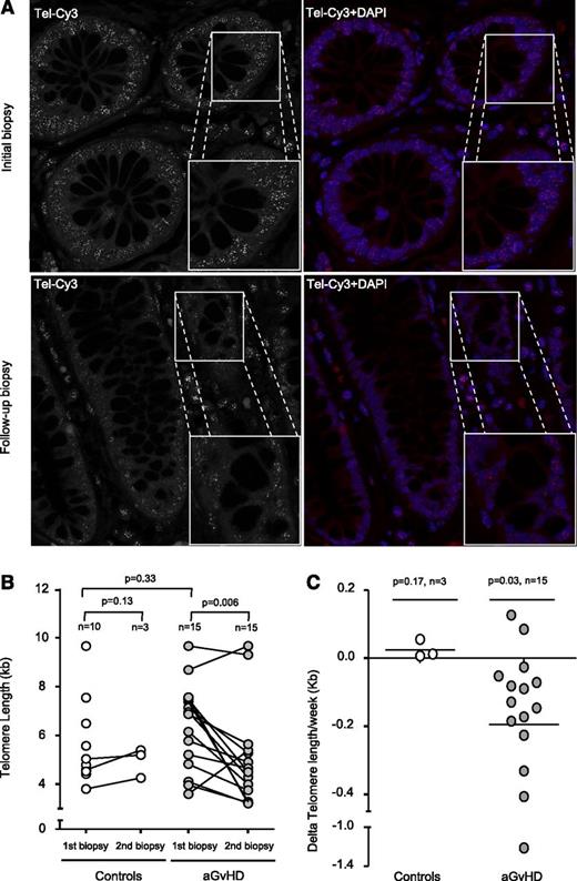Figure 2. Telomere shortening in aGVHD patients. (A) Representative confocal microscopy images of the 2 gut biopsies from an aGVHD patient analyzed by Q-FISH. The upper panels represent the initial biopsy, and lower panels the follow-up biopsy. Telomeres were stained with Tel-Cy3 peptide nucleic acid probe, and chromatin was stained with 4,6 diamidino-2-phenylindole (DAPI). Black-and-white images of the telomere signal are shown to improve comparability. Micrograph magnification is ×100. (B) Longitudinal analysis shows that TL is significantly reduced in aGVHD patients but not in controls. One circle corresponds to 1 biopsy. One connecting line corresponds to 1 individual patient. (C) Telomere shortening is shown for the enterocytes of aGVHD patients with a mean telomere loss rate of −0.19 per week compared with enterocytes of the control.