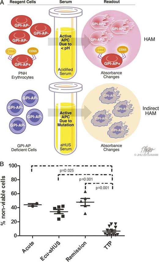 Figure 3. A) Model of Ham test for PNH (top) and indirect Ham test for aHUS diagnosis (bottom). The Ham test evaluates the effect of acidified serum on patient's cells, whereas the modified test evaluates the effect of patient's serum on GPI-anchored protein–deficient reagent cells. Both tests use absorbance changes as readouts of cell viability. GPI-AP indicates glycosylphosphatidylinositol-anchored proteins. B) WST-1 cell viability assay in patients with aHUS. Percentage of nonviable reagent cells in aHUS after exposure to acute-phase serum, remission serum on eculizumab (Ecu), and remission serum off eculizumab compared with acute or remission serum from TTP patients.