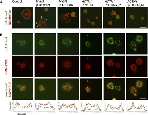 Figure 1. Localization of α-actinin 1 and NMMHCIIA in platelets. (A) Localization of α-actinin 1 and NMMHCIIA in resting platelets. Peripheral blood smears were stained with anti-α-actinin-1 antibody (Alexa Fluor 488, green) and anti-NMMHCIIA antibody (Alexa Fluor 555, red). Merged images are shown. There were abnormal NMMHCIIA aggregations in the neutrophils of patients with MYH9 disorders (indicated by arrow heads). M, mother; P, patient. Scale bar, 20 μm. (B) Localization of α-actinin 1 and NMMHCIIA in surface-activated spreading platelets. Surface-activated platelets were double-stained with anti-α-actinin-1 antibody (green) and anti-NMMHCIIA antibody (red). The fluorescence intensity of α-actinin-1 (green) and NMMHCIIA (red) along the lines of interest on the merged images was measured using the ImageJ plot profile function (National Institutes of Health, Bethesda, MD) and the data were exported to Microsoft Excel for the construction of graphs. Representative images from 10 spreading platelets in each individual are shown. The granulomere zone is indicated by dotted lines. Scale bar, 20 μm.