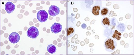 A 48-year-old HIV-positive man on highly active retroviral therapy presented with fevers, chills, and a new pleural effusion. Imaging did not identify organomegaly or mass lesions. A cytospin of thoracentesis fluid showed large, highly pleomorphic neoplastic cells with prominent nucleoli and deeply basophilic cytoplasm with perinuclear hofs (clearing), consistent with plasmacytic differentiation (panel A). Flow cytometry showed the neoplastic cells lacked T- or B-cell markers but expressed plasma cell-associated antigens. Immunohistochemistry for human herpesvirus-8 (HHV-8)–encoded latency-associated nuclear antigen demonstrated positive, stippled nuclear staining (panel B). The findings are characteristic for primary effusion lymphoma (PEL). This patient developed septic shock and died prior to therapy initiation. / PEL occurs most frequently in HIV-infected individuals and primarily involves body cavities. HHV-8 is present in all cases and serves as a key diagnostic criterion; Epstein-Barr virus coinfection is common. In contrast to PEL, HHV-8–negative effusion-based lymphomas tend to occur in HIV-negative elderly, are sometimes associated with hepatitis C infection or chronic inflammation-related pyothorax, and are reported to have better prognosis. PEL is generally resistant to chemotherapy with a short survival of <6 months. However, recent advances exploring mechanisms of HHV-8 oncogenesis have suggested potential novel therapeutic targets, such as nuclear factor κB, the proteasome, and cytokine signaling.