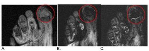 Figure 1. Patient with 1st distal phalanx osteomyelitis. STIR T2 weighted image precontrast (A), STIR T2 weighted image approximately 16 hours post-ferumoxytol (B), and Heme weighted T2* image (C.) about 16 hours post ferumoxytol showing hypo-enhancement in areas of macrophage iron uptake in distal 1st phalanx in the post-ferumoxytol scans.