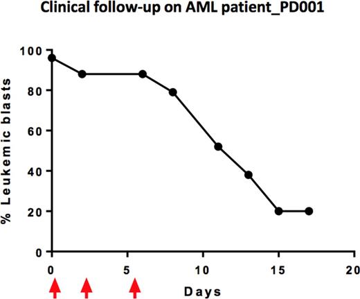 Figure 2. Clinical follow-up of AML patient-PD001 shows chemosensitivity to bortezomib (Velcade). Arrows arrows indicate dosing. Velcade decreased the percentage of leukemic blasts from 96% to 20%.