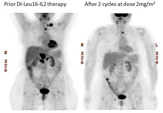 Figure 1. 65 year old female with diffuse large B cell lymphoma treated at dose level 2mg/m2 received 2 cycles of DI-Leu16-IL2. Treatment resulted in partial regression of multiple lymph node sites.