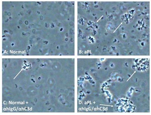 Figure 2. iEMs incubated with aPL plasma (B, D) and plasma from a healthy donor (A, C) visualized with bright field microscopy. Aggregate formation seen after incubation with aPL plasma (B) is hardly seen with normal plasma (A); Agglutinate formation after addition of anti-hIgG/anti-hC3d (C, D) is amplified in aPL plasma (D) compared to normal plasma (C). Examples of aggregates are indicated with white arrows.