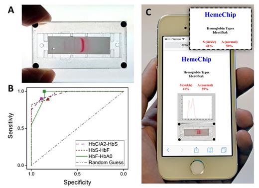 Figure 1. Mobile micro-electrophoretic device (HemeChip) for point-of-care screening for sickle cell disease. ( A) HemeChip prototype is shown with a miniscule blood sample that has been separated into characteristic hemoglobin bands. (B) The receiver Operating-Characteristic (ROC) curves show sensitivity and specificity of HemeChip for differentiating between adjacent hemoglobin bands based on the travelling distance from the sample application point. band traveling distance thresholds are shown: circle=7.5 mm, triangle=10.0 mm, and square=12.5 mm. (C) Web-based image processing application for automated and objective quantification of HemeChip results at the POC using cloud computing resources.