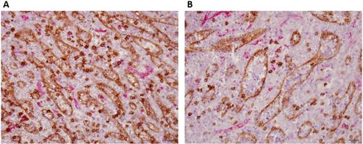 Figure 2. Immuno-double staining of SLC and SEC, CD8 (brown), CD34 (red). / A. Normal spleen. / B. MF spleen