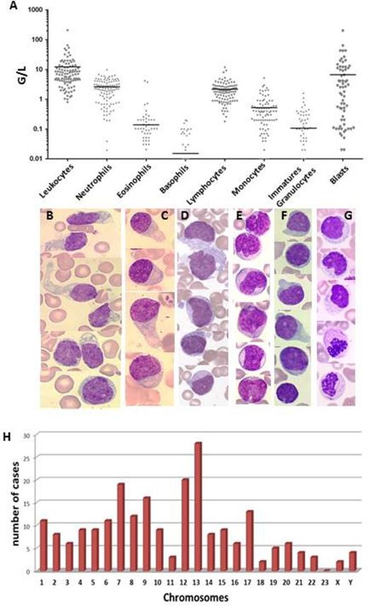 Figure 1. A: Blood cell count in 109 BPDCN patients at diagnosis. Bars represent the median. B: Typical BPDCN morphology. C: In this case, the nuclei were peripheral, cytoplasm presented heterogenous basophilia, vacuoles were rare but large pseudopodia are frequent. D: Typical morphology with frequent microvacuoles under the cytoplasmic membrane. E: Immature morphology. F: Pseudolymphocytic morphology. G: Presence of dysplasia in myeloid cells with Auer Rods in the granulocytes. The morphology of the Blastic cells is typical. H. Chromosomal abnormalities in 78 caryotypes evaluated: The histogram represents the number of cases in which each chromosome was involved (deletion, gain, translocations).