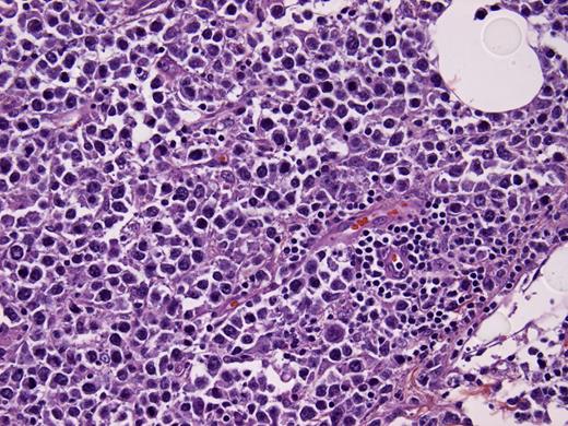 Figure 1. H&E (40x). Tissue sample (study patient) showing cancer cells admixed with stromal elements
