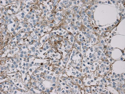 Figure 2. MCT4 stain (40x) demonstrating exclusive staining of stromal cells, sparing cancer cells