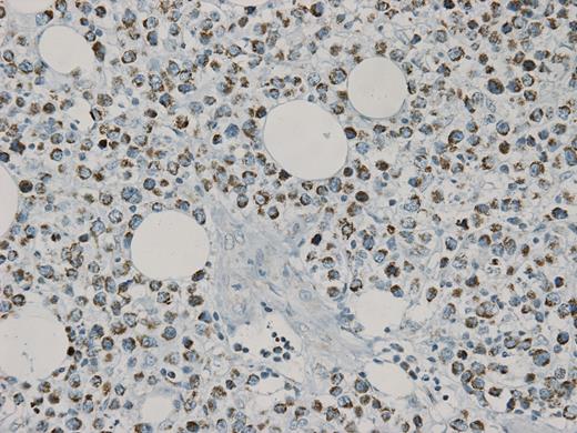 Figure 3. TOMM-20 stain (40x) demonstrating 2+ staining of cancer cells, sparing stromal cells