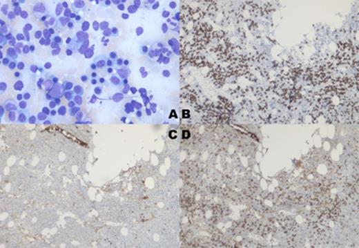 Figure 1. A. Aspirate showing abnormal plasma cells. B. Trephine CD138 stain. C. Trephine kappa light chain stain. D. Trephine lambda light chain stain.