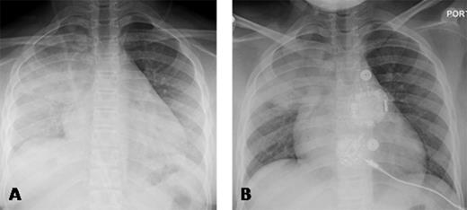 Figure 1. Panel A demonstrates the chest x-ray 3 hours prior to PEG-COHb with right upper lobe consolidation and evolving bilateral lower lobe consolidation and Panel B 29 hours following administration of PEG-COHb demonstrating improvement in the lower lobes.
