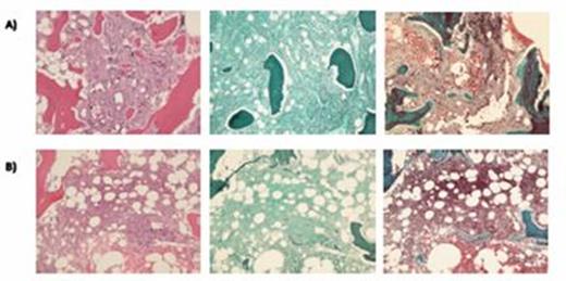 Figure 1. Bone marrow pathology slides comparing A) Grade 2 of 3 Myelofibrosis during