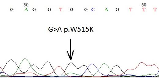 Figure 1. W515K mutation first case with ET