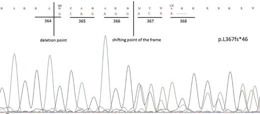 Figure 2. CALR type I mutation in second case with ET.