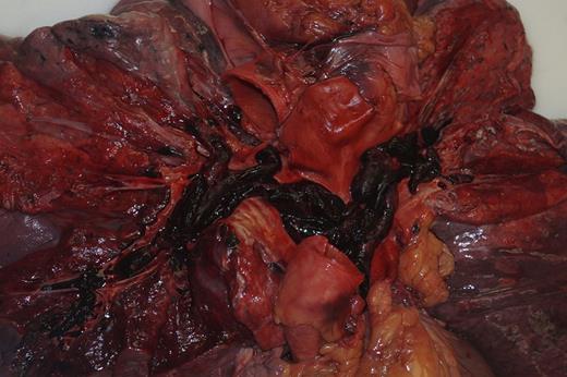 Figure 1. Massive pulmonary artery thromboembolism in situ, gross examination.