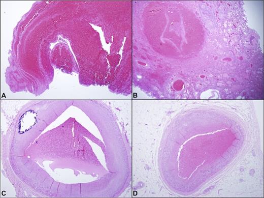Figure 2. Histology, hematoxylin and eosin. A. Pulmonary thromboembolus at the bifurcation of the pulmonary arteries and pulmonary trunk. B. Hemorrhagic infarct and thromboemboli in varying stages of organization, right lower lobe, lung. C. Cross section of the proximal left anterior descending coronary artery with thromboembolus. D. Cross section of the posterior descending coronary artery with thromboembolus.
