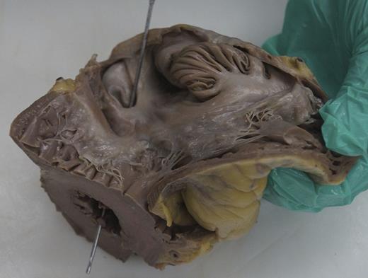 Figure 3. Patent foramen ovale, gross examination.