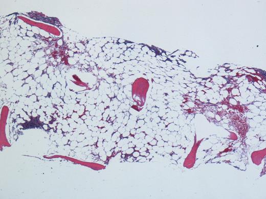 Figure 1. Hypo-cellular Bone Marrow