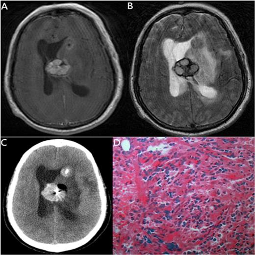 Figure 1. The MRI, biopsy site and pathology of a 60-year-old man with CMML