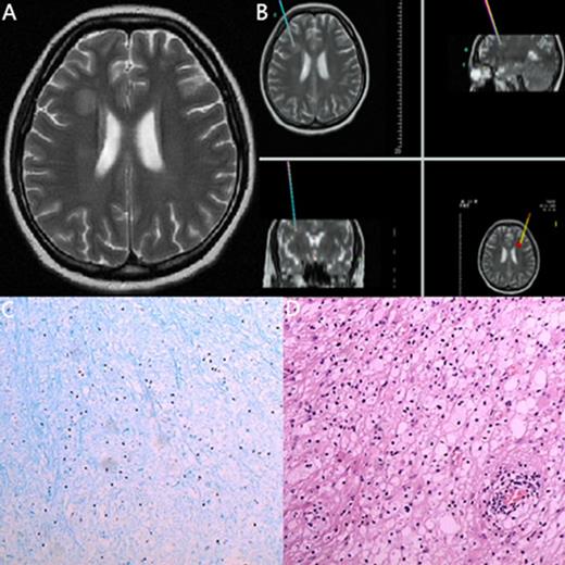 Figure 2. The MRI, biopsy site and pathology of a 23-year-old woman with ALL