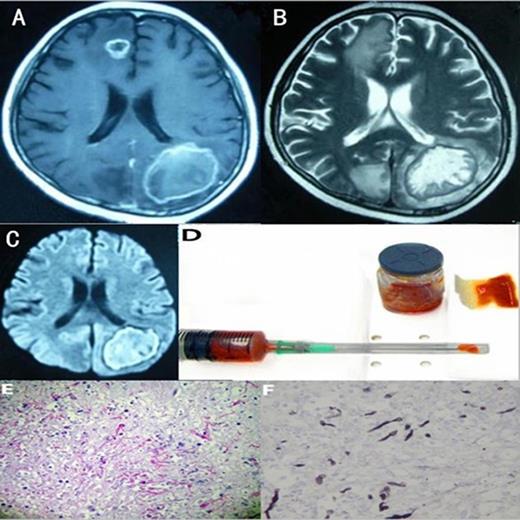 Figure 3. The MRI, biopsy material and pathology of a 15-year-old man with AML (M5)