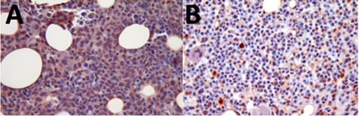 Figure 1. Activated FLT3 levels in patient responsive to ASP2215; pre-treatment (A) and post-treatment (B)