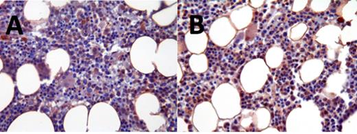 Figure 2. Activated FLT3 levels in patient not responsive to ASP2215; pre-treatment (A) and post-treatment (B)