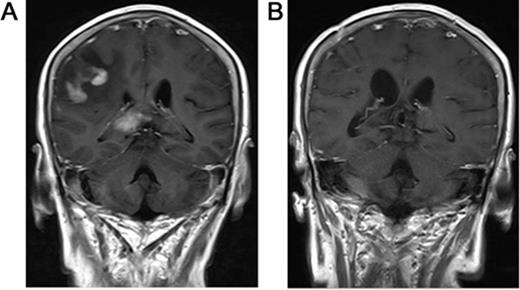 Figure 3. T1 axial, post-gadolinium magnetic resonance imaging of PCNSL.