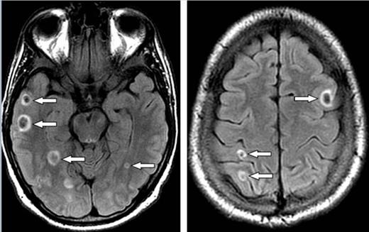 Figure 1. MRI brain FLAIR images show multiple ring like foci of recent hemorrhages (arrows).