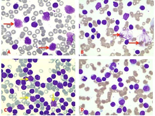 Figure 1. Blood smears of patients with CLL. A, B, C : presence of smudge cells (arrows). D : blood smear without smudge cells.