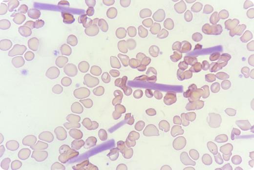 A 66-year-old Chinese woman with stage IV breast cancer presented to the clinic for assessment before her sixth cycle of palliative chemotherapy with cyclophosphamide and doxorubicin. Peripheral blood counts by automated blood count analyzer (DxH 800; Beckman Coulter) revealed that hemoglobin was 8.8 g/dL, leukocytes were 5.6 × 109/L, and platelets were 250 × 109/L, with a warning for platelet clumps, which prompted blood film review. Examination of blood film did not show platelet clumps but did show multiple extracellular cylindrical crystals that resolved with warming to 37°C. Serum testing confirmed the presence of cryoglobulin, and an immunofixation study showed a tiny immunoglobulin G κ band that could not be quantified due to low concentration. The patient had no lymphadenopathy, splenomegaly, features of vasculitis, or connective tissue disease but was on prophylactic lamivudine for chronic hepatitis B infection. Test results for anti–hepatitis C virus were negative. She declined further workup with bone marrow examination, and the cause of cryoglobulinemia could not be ascertained. / Cryoglobulins, in the form of amorphous pale staining material, are known to cause spurious platelet and leukocyte counts by automated blood count analyzers. Presentation as extracellular crystals is rarely reported in the literature.