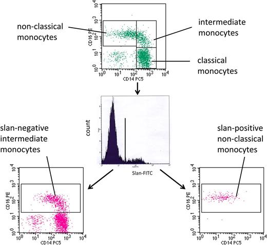 Figure 4. slan-based CD16-positive monocyte subsets in sarcoidosis. Whole blood from a sarcoidosis patient (ID 2074) was stained with monoclonal antibodies to CD14, CD16, HLA-DR, and slan and analyzed in 4-color flow cytometry. Monocyte subsets defined in the CD14 CD16 dot plot (top) are classical (427.6 cells per microliter), intermediate (101.6 cells per microliter), and nonclassical monocytes (123.2 cells per microliter). Separation based on slan reveals slan-positive nonclassical monocytes (61.0 cells per microliter) (bottom right) and slan-negative intermediate monocytes (164.7 cells per microliter) (bottom left).