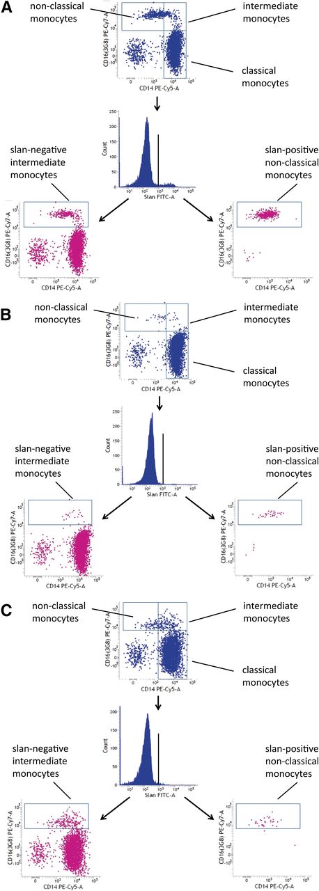 Figure 6. CD16 monocyte subsets in HDLS. (A) Control subject 665. (B) HDLS case 667. (C) HDLS case 745. The slan-positive nonclassical monocytes are depleted in every HDLS case.