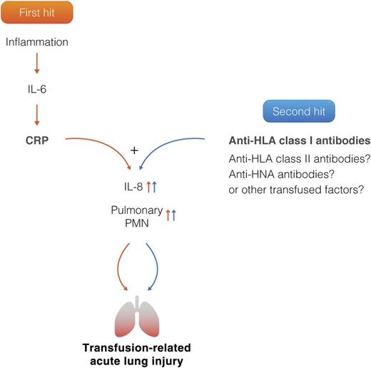 Two-hit model of TRALI. The first hit represents patient predisposing factors including CRP, which is now identified as a novel first hit by the current study. The second hit represents antibodies and factors directly related to the transfused blood product. Inflammation causes an increase in IL-6, which stimulates a rapid elevation of CRP. CRP together with anti-HLA class I antibodies trigger a synergistic increase in both IL-8 and pulmonary polymorphnuclear neutrophil (PMN) accumulation, resulting in TRALI induction. CRP or anti-HLA class I antibodies alone are not sufficient to induce TRALI. Professional illustration by Somersault18:24.