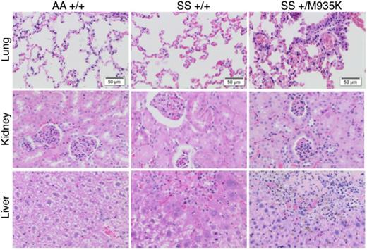 Figure 6. Activated Kcc1 cotransporter promotes end-organ damage in sickle cell disease. Histologic sections of lung, kidney, and liver stained with hematoxylin and eosin. Tissues were harvested from 10-week-old wild-type mice (AA+/+), sickle homozygous mice (SS+/+), and sickle homozygous with heterozygous Kcc1 mutation (SS+/M935K). Sections are representative of 3 mice of each genotype.