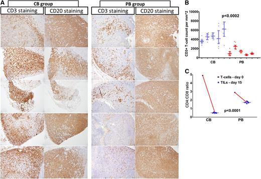 Figure 3. Cord blood T cells are rapidly recruited to the tumor compared with peripheral blood T cells. (A) Contiguous tumor sections (×10) of the CB and PB groups stained with CD3 and CD20 immuno-histochemical stain. Higher numbers of tumor-infiltrating CD3+ T cells were seen in the CB group compared with the PB group. (B) Density of tumor-infiltrating T cells per square millimeter (shown as scatter dot plot with median and interquartile range) was significantly higher in the CB group than in the PB group. Importantly, as shown in C, a significantly lower CD4:CD8 ratio was observed in CB TILs compared with PB TILs, suggesting higher numbers of CD8+ T cells infiltrated the tumor in the CB group compared with the PB group.