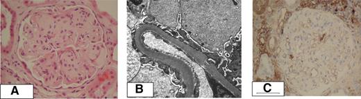 Figure 1. Histology in LCDD. (A) Nodular glomerulosclerosis. High power view of a glomerulus exhibits mesangial expansion by periodic acid-Schiff–positive matrix that focally forms nodules with peripheral expansion producing lobules (periodic acid-Schiff stain, magnification ×400). (B) Granular electron dense deposits along the lamina rara interna of the glomerular basement membrane are seen on electron microscopy (magnification ×11 500). (C) Absence of specific mesangial staining with anti-λ antibodies, despite the presence of high background staining (magnification ×600).