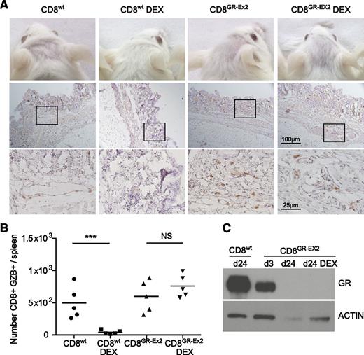 Figure 5. Resistance to DEX and functional activity of TALEN-modified CD8+ T cells in a xeno-GVHD model. (A) Hair loss (top row) and skin infiltration with human CD45+ cells counterstained with hematoxylin (middle row; inset shown in bottom row) from irradiated NSG mice injected with 1 × 106 CD8+wt or CD8+GR-Ex2 T cells and treated daily or not with intraperitoneally injected DEX at 15 mg/kg for 21 days. (B) Absolute number of human GZB-expressing (GZB+) CD8+wt or CD8+GR-Ex2 T cells in the spleens of previously described NSG mice. (C) Western blot analysis of GR expression from human-selected cells in pooled spleens ex vivo and at day 3 after transfection with TALENs. Data are representative means from 2 independent experiments with 5 mice per group; statistical analysis was performed by 1-way ANOVA (***P < .001) with Bonferroni multiple comparisons.