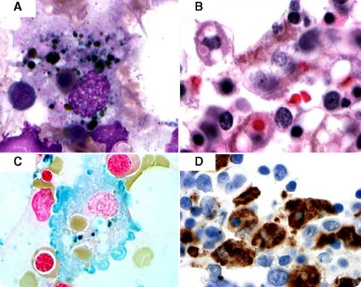 Hemophagocytic lymphohistiocytosis (HLH) is a rare, potentially fatal syndrome despite treatment. It is caused by a dysregulation in natural killer T-cell function, resulting in activation and proliferation of histiocytes with uncontrolled hemophagocytosis and cytokine overproduction. HLH can be either primary, with a genetic etiology, or secondary, associated with malignancies, autoimmune diseases, or infections. There is sparse literature on HLH cases associated with granulomatosis with polyangiitis (GP). Here, we report a 59-year-old woman, with a medical history of GP, chronic anemia, and rapidly progressive glomerulonephritis, who presented with weakness, fatigue, dysuria, cough, and fever with chills for 2 weeks. She developed neutropenia with a white blood cell count of 500/μL and hemoglobin level of 5.1 g/dL, with elevated ferritin levels (>40 000 ng/mL), low haptoglobin level, and increased triglyceride level of 2.66 mmol/L. Bone marrow aspirate and biopsy showed increased histiocytes with intracytoplasmic erythroid precursors, red blood cells, and hemosiderin pigment consistent with hemophagocytic syndrome (panels A-B). Iron stain and CD68 showed histiocytes (panels C-D). The patient was treated with dexamethasone and died within 4 days. Autopsy findings showed arterial thromboemboli with infarcted lungs, liver, and spleen. / The authors report this case to draw attention to this severe syndrome that may often go undiagnosed in patients with rheumatic diseases, especially GP.