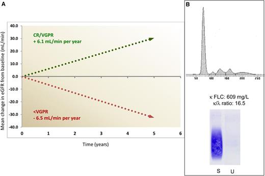 Impact of response on progression of renal damage and challenging electrophoretic pattern in light chain deposition disease. (A) Mean annual change in estimated glomerular filtration rate (eGFR) in patients attaining a VGPR or CR, compared with patients reaching less than VGPR. Only 14% of patients in VGPR or CR required dialysis, compared with 64% of other subjects. (B) The serum electrophoresis scan (top) and anti-κ immunofixation (bottom) show no monoclonal immunoglobulin in a patient with LCDD and with a serum κ free LC (FLC) concentration of 609 mg/L and a greatly abnormal FLC ratio. In our population of 68 patients with LCDD, a monoclonal protein was detected by serum and urine electrophoresis/immunofixation in only 60% of the patients, whereas FLC concentration and ratio were abnormal in all. S, serum; U, urine.