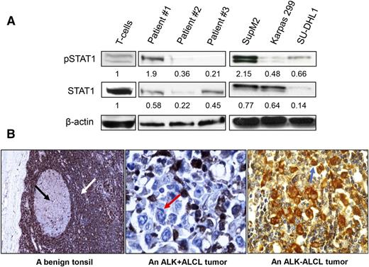 Figure 1. Expression of STAT1 in ALK+ ALCL cell lines and patient samples. (A) Western blot studies revealed a relatively low expression level of STAT1 in 3 ALK+ ALCL tumors and 3 cell lines compared with that of normal peripheral blood T cells. Densitometry values shown were normalized to the β-actin bands. Most cases also had a low expression level of pSTAT1. (B) Immunohistochemical study results showed the expression of STAT1 in paraffin-embedded tissues derived from a representative benign tonsil (left, ×100 magnification), a representative ALK+ ALCL tumor (middle, ×400 magnification), and a representative ALK− ALCL tumor (right, ×200 magnification). In benign tonsils, the interfollicular T cells (white arrow) were strongly STAT1-positive, whereas the germinal center B cells (black arrow) were STAT1-weak. In the ALK+ ALCL tumor, the infiltrating T cells were strongly positive for STAT1, whereas the large lymphoma cells (red arrow) were virtually negative for STAT1. In the ALK− ALCL tumor, the large lymphoma cells (blue arrow) were strongly positive for STAT1.
