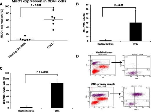 Figure 2. Selective expression of MUC1 in CTCL patients. (A-D) PBMCs from 6 patients with L-CTCL with previously identified unique TCR Vβ rearranged malignant clone and 6 corresponding normal donors were isolated and analyzed for MUC1 and CD4 expression by flow cytometry. Each dot represents an individual patient or control, and results are presented as percentage of cells expressing MUC1 in the CD4+ population (A); TCR Vβ expression was analyzed in the CD4+ subset of cells (B), and MUC1 expression was further analyzed in the CD4+, TCR Vβ+ subset of cells (C). Representative FACS plots of a patient with L-CTCL and healthy donor are shown (D).