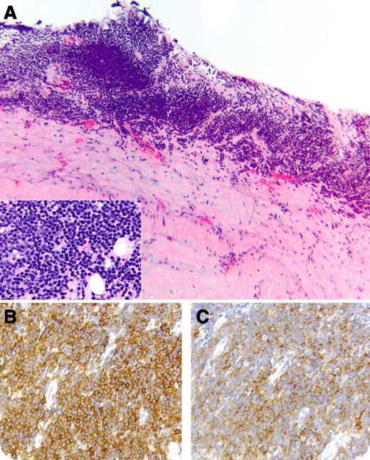 A 71-year-old male presented with fatigue, progressive dyspnea, weight gain, and anasarca. The complete blood count showed a white blood cell count of 7,000/μL with a normal differential count and no cytopenias. Imaging studies revealed bilateral pleural effusions, pericardial effusion with thickened pericardium, and constrictive heart physiology, ascites, and scattered lymphadenopathy without pathological enlargement. Fluid obtained during thoracentesis, pericardiocentesis, and paracentesis was negative for malignancy by microscopic examination (immunophenotyping was not performed). Following rapid recurrence of anasarca, the patient underwent a total pericardiectomy. Examination of pericardial tissue showed fibrous pericarditis and an extensive bandlike infiltrate consisting of small lymphocytes with round nuclei and scant cytoplasm (panel A and inset). Cells expressed CD5 (panel B), CD19, CD20 (weak) (panel C), and CD23. The bone marrow biopsy showed a small population of monoclonal B cells, consistent with chronic lymphocytic leukemia (CLL)/small lymphocytic lymphoma (SLL). Despite receiving prednisone, the patient had recurrent pleural effusions, immunophenotypically positive for CLL. He received therapy with fludarabine and rituximab; however, he succumbed to infectious complications. A postmortem examination revealed no residual CLL. / Pericardial invasion is an extremely unusual initial presentation for CLL/SLL. Although a “passenger effect” cannot be ruled out, the absence of a concurrent inflammatory process speaks in favor of pathological leukemic involvement, which needs to be included in the differential diagnosis of lymphocytic infiltrates of the serosal surfaces.