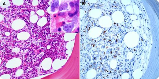 A 64-year-old female with neck/back pain and vaginal bleeding was found to have anemia (hemoglobin 7.4 g/dL), leukocytosis (white blood cell count 22 800/µL), thrombocytosis (platelets 549 000/µL), and elevated creatinine at 2.7 mg/dL and calcium at 17 mg/dL. Image studies demonstrated multiple lytic bone lesions. A plasma cell myeloma was highly suspected. A diagnostic bone marrow (BM) biopsy was promptly performed. BM aspirates showed scattered, large anaplastic cells intimately mixed with hematopoietic cells. The BM core biopsy demonstrated scattered atypical infiltrate in a single-cell fashion in a background of trilineage hematopoiesis (panel A). The infiltrating tumor cells were medium to large in size, having irregular nuclear contours and fine chromatin with small but distinct nucleoli (panel A, inset). Immunohistochemistry was completely negative for pancytokeratin, S-100 protein, and CD45, CD3, CD20, CD30, CD34, CD138, κ, or λ light chain, and essentially ruled out common epithelioid, melanocytic, or hematopoietic neoplasms. However, they were positive for desmin (panel B), myogenin, and myoD1, consistent with metastatic rhabdomyosarcoma in the BM. Further image studies revealed a cervical/uterus mass, which was confirmed as a pleomorphic rhabdomyosarcoma by a subsequent tissue biopsy. / Metastatic rhabdomyosarcoma in the BM presenting as scattered malignant cells as illustrated in the current case is an extremely rare occurrence and poses a great diagnostic challenge, especially when the primary tumor is unrecognized.