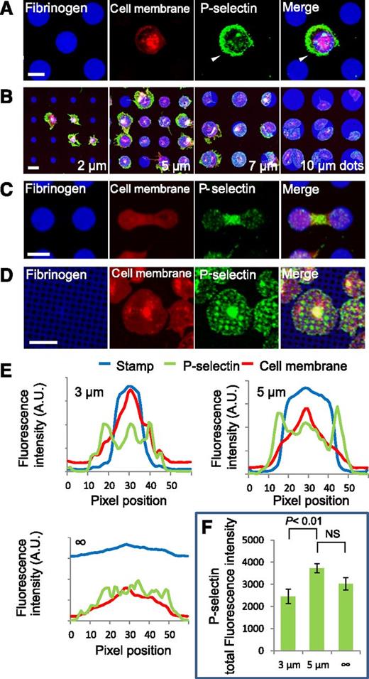 Figure 2. Platelet α-granule secretion is spatially regulated at the micro- and nanoscales. (A) Platelet spreading beyond protein microdot (blue) boundaries is associated with increased P-selectin expression (green) in those specific regions of unpermeabilized platelets (red). Individual fluorescence microscopy channels and a merged image of all 3 channels are shown. (B) High levels of anti–P-selectin staining colocalize with regions of platelets that spread beyond the geometric boundaries of protein microdots, and this effect inversely correlates with microdot size. (C) Permeabilized platelets on adjacent protein microdots form bridging connections associated with high levels of P-selectin in those regions. (D) Protein micropatterns with arrays of nanoscale “holes” reveal that P-selectin colocalizes with the patterned holes in permeabilized platelets. (E) Averaged (n = 7-10 platelets) fluorescence intensity line plots of P-selectin expression (green) on platelets (red, membrane dye) that spread beyond 3- and 5-µm diameter fibrinogen microdots (blue) show peak P-selectin expression outside the micropattern boundaries, whereas no clear peak is shown in platelets that spread on evenly coated fibrinogen surfaces. (F) Total P-selectin signal intensity is significantly increased on platelets spread on 5-µm diameter microdots compared with platelets on 3-μm microdots, but was not significantly different compared with platelets on evenly coated surfaces (“∞” µm diameter). The scale bars = 5 µm.