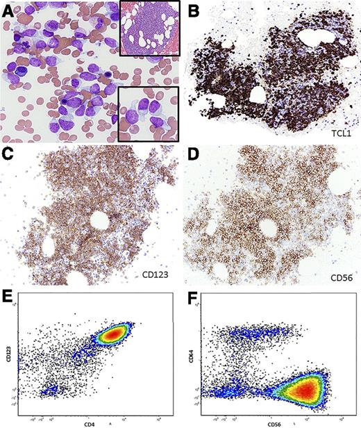A 63-year-old man presented with cutaneous nodules. Workup revealed anemia, thrombocytopenia, monocytosis, and 5% circulating “blasts.” Bone marrow sampling showed 33% immature-appearing cells (panel A), with occasional “tadpole” appearance (panel A, lower inset) and an 80% cellular marrow with an interstitial infiltrate (panel A, upper inset). The neoplastic cells were positive for TCL1, CD123, and CD56 by immunohistochemistry (panels B-D). Flow cytometry demonstrated CD4, CD56, and CD123 expression (panels E-F), with absence of CD34 and lineage-specific markers. Cytogenetic analysis showed no clonal abnormalities, and next-generation sequencing showed 2 TET2 mutations (1 missense and 1 nonsense mutation: NM_001127208.2:c.3781C>T p.R1261C and c.2737C>T p.Q913*, respectively). A diagnosis of leukemic/disseminated blastic plasmacytoid dendritic cell neoplasm (BPDCN) was established. Biopsy of the cutaneous nodules confirmed involvement by BPDCN. / BPDCN is a rare neoplasm with poor prognosis. Acute myeloid leukemia (AML) has been reported in ∼20% of BPDCN patients and tends to arise metachronously. Distinguishing BPDCN from AML can be challenging. The tadpole or “hand mirror” appearance of the cells is helpful, but identifying the characteristic immunophenotype is essential in establishing the diagnosis. Recent data suggest that acute lymphoblastic leukemia-type regimens may be more effective compared to standard approaches using AML-type regimens in BPDCN. A therapeutic role may exist for agents targeting the nuclear factor κB pathway. An accurate diagnosis of BPDCN becomes more critical as targeted therapeutic options become available.