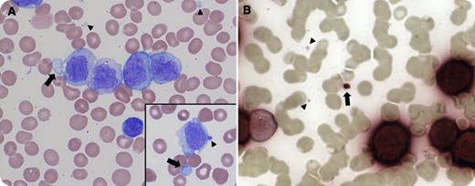 A 19-year-old man presented with fever and gum pain for 2 weeks. Physical examination revealed pallor, gingival hyperplasia, and cervical and axillary lymphadenopathy. Automated blood count demonstrated 115 × 103/mm3 white blood cells, 10.7 g/dL of hemoglobin, hematocrit 31.5%, and 42 × 103/mm3 platelets. Peripheral blood smear revealed 85% monoblasts and promonocytes (blast equivalents) as well as cytoplasmic leukemic cell fragments (arrows) mimicking platelets (arrowheads) (panel A and inset). The blasts and “pseudoplatelets” (arrow) stained for nonspecific esterase, confirming their monocytic leukemic origin, whereas platelets (arrowheads) were negative (panel B). The pseudoplatelets accounted for 20% of the platelets counted by the automated counter. Flow cytometry confirmed the diagnosis of acute monocytic leukemia. / A spuriously elevated platelet count resulting from leukemic cell fragmentation can be seen in almost all subtypes of acute myeloid leukemia (AML) as well as acute lymphoblastic leukemia, but it is particularly associated with AML with maturation and with acute monoblastic and monocytic leukemias. Therefore, platelet counts obtained by an automated counter may overestimate the true platelet count. Clinicians and pathologists should evaluate the peripheral blood smear visually at diagnosis and before invasive diagnostic and therapeutic interventions to minimize bleeding risk.
