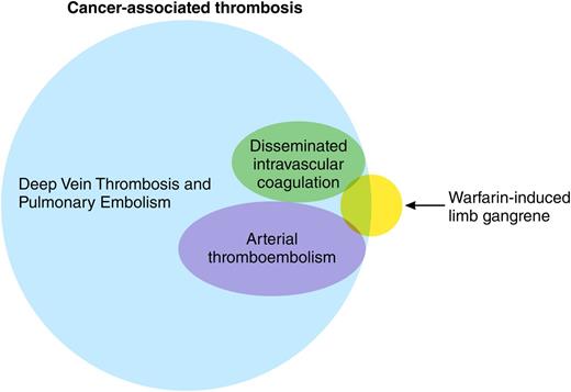 Myriad manifestations of cancer-associated thrombosis.